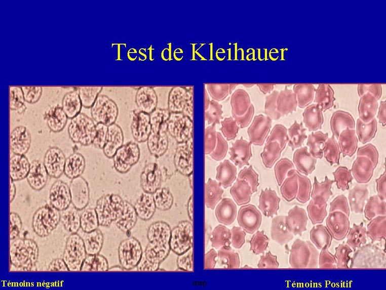 test de kleihauer positif