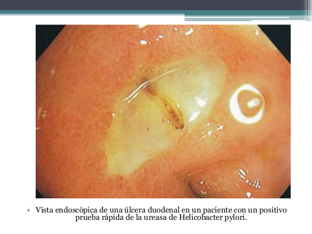 test de ureasa positivo